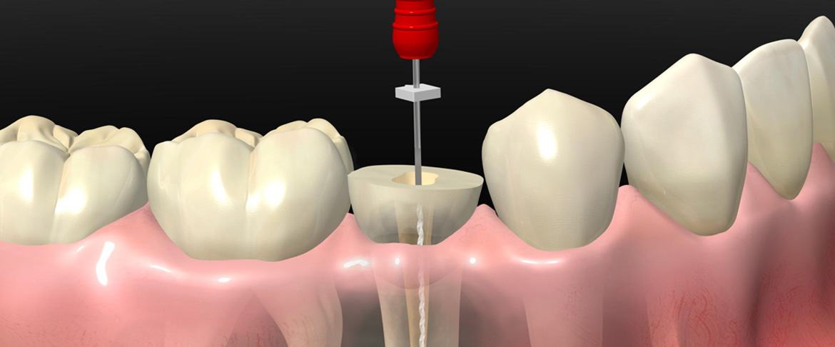 ENDODONZIA