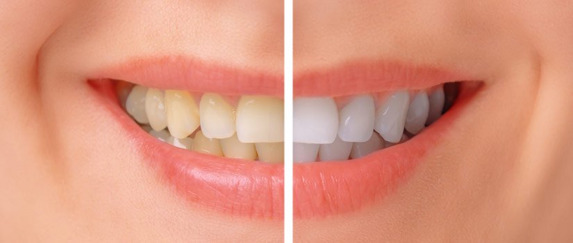 SBIANCAMENTO DENTI