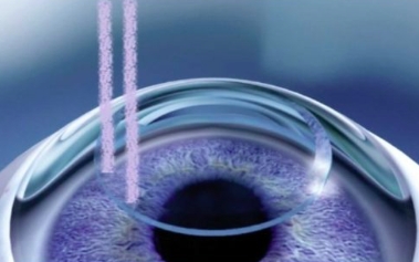 Laser ad Eccimeri
